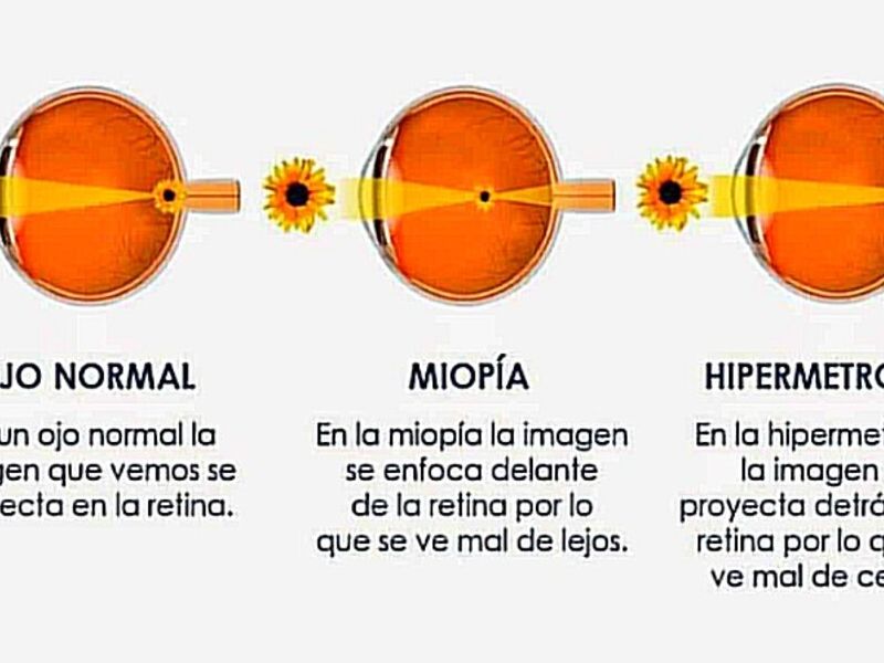 Hipermetropía Quito