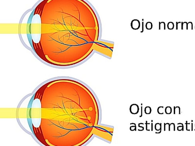 Astigmatismo Quito