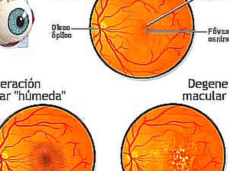 Degeneración macular Quito